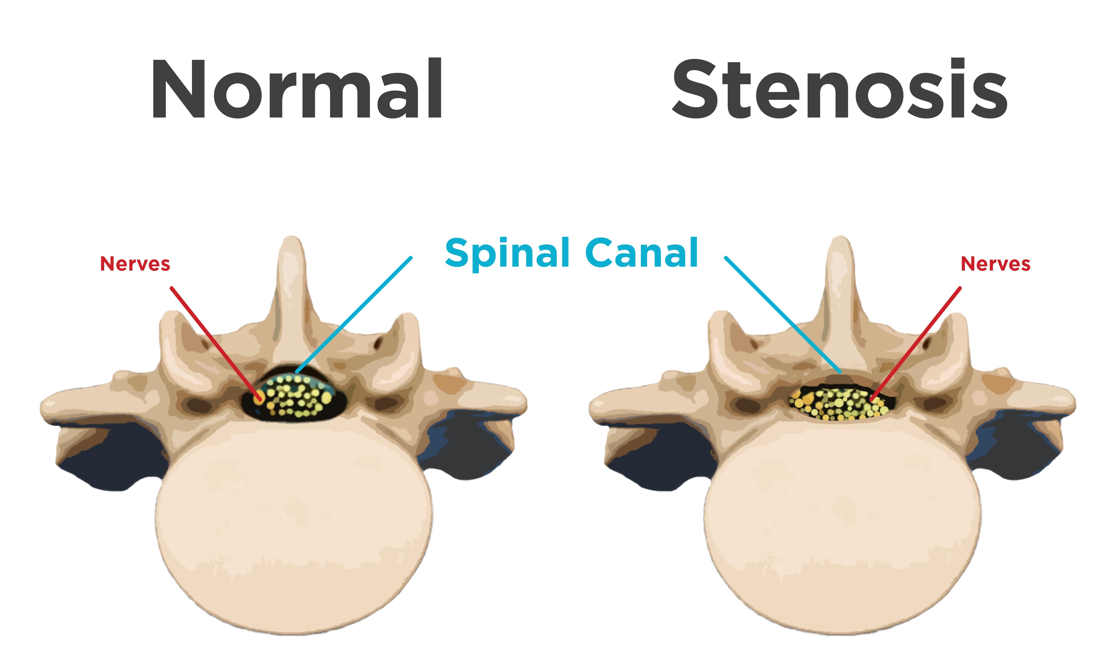normal-vs-spinal-stenosis-in-vertebrae-01