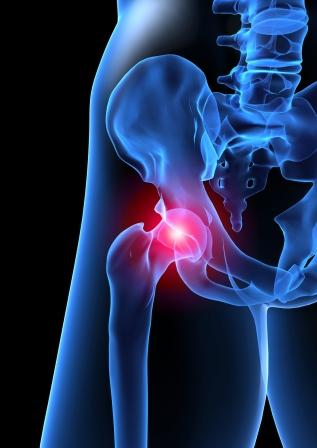 Is It My Low Back Or My&nbsp;Hip?