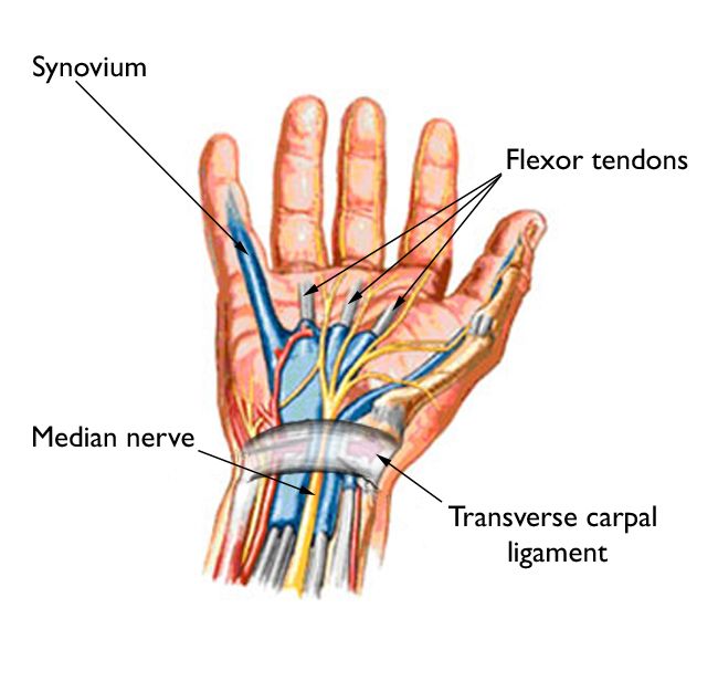 Carpal Tunnel Syndrome Linked to Migraine&nbsp;Headaches